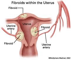 Fibroids-Uterus